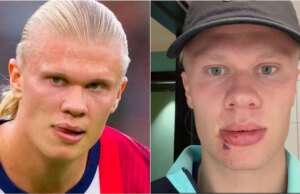 Erling Haaland subisce uno strano infortunio al viso sull’autobus della squadra norvegese