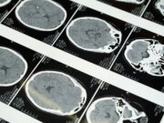 La corsa alla tecnologia del cervello a ultrasuoni in Cina si riscalda