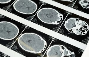 La corsa alla tecnologia del cervello a ultrasuoni in Cina si riscalda