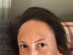 Miranda Hart rivela di essersi fatta male alla caviglia e di non riuscire a camminare correttamente mentre parla della sua ansia per l’estrema paura dell’assistenza sanitaria