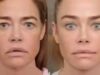 Le foto prima e dopo di Denise Richards dopo il restyling diventano VIRALI
