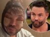 Bobby Norris di TOWIE afferma di soffrire di insonnia mentre mostra il suo viso gonfio nel nuovo aggiornamento dopo aver subito ulteriori interventi di chirurgia estetica