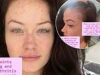 Jess Impiazzi, incinta, documenta la sua battaglia contro il Lupus che le ha cambiato la vita, condividendo foto honest di eruzioni cutanee e perdita di capelli e affermando: “Non mi sono mai sentita così persa”