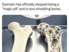 Ozempic distrugge le ossa? Come un piccolo studio si è trasformato in un grande mito sulla salute