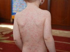 Quell’attacco adolescenziale di mononucleosi potrebbe avere un secondo atto preoccupante