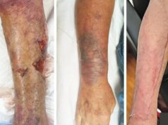 Ecco come appare una gamba devastata dai batteri “mangia-carne”