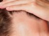 ‘Rogaine’ in una pillola? Minoxidil orale Aces, prova importante contro la perdita dei capelli