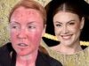 La moglie della star Chris Robshaw, Camilla Kerslake, sembra irriconoscibile con il viso bruciato e sanguinante dopo essersi sottoposta a un trattamento laser gratuito da £ 1.000